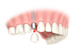 Crown made for one dental implant